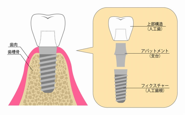 インプラント治療について