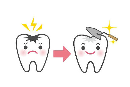 できる限り歯を削らない治療