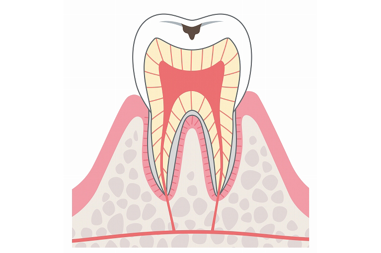 エナメル質へ進行したむし歯