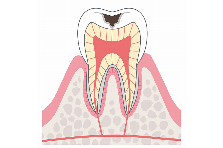 象牙質まで進行したむし歯