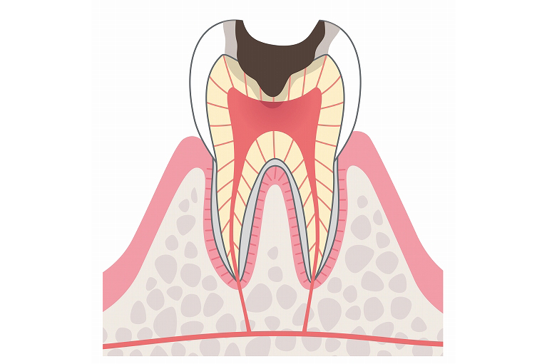神経まで達したむし歯
