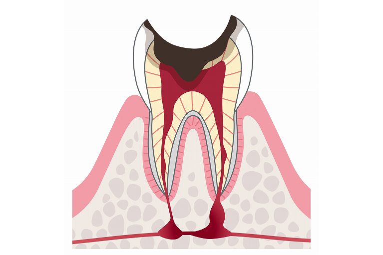 歯が崩壊して歯根が残ったむし歯
