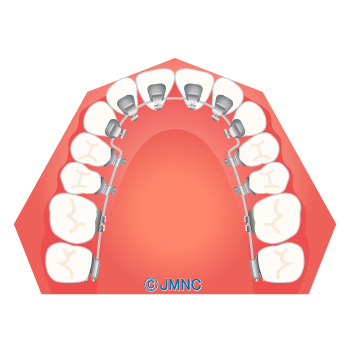 リンガルブラケット（舌側矯正）