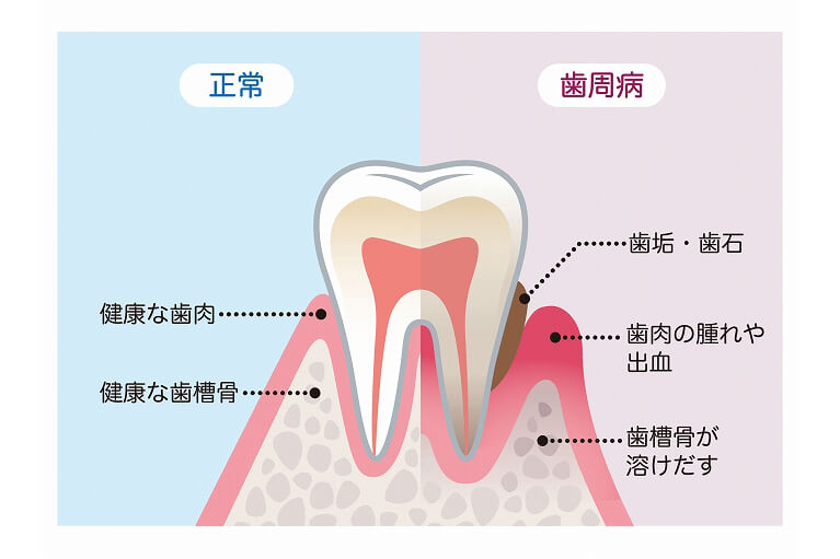 歯周病について