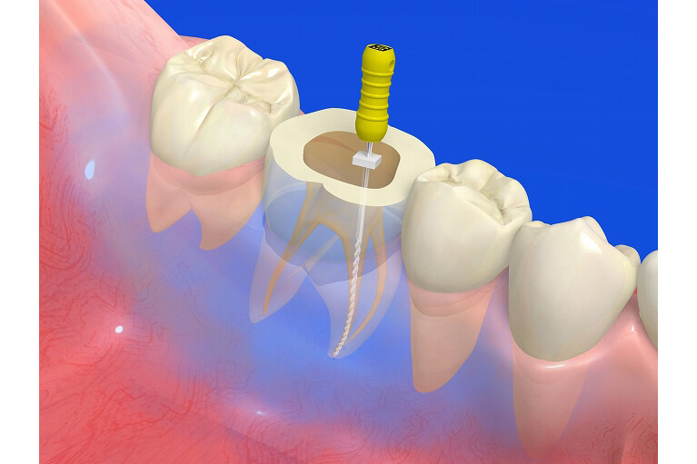 根管治療について